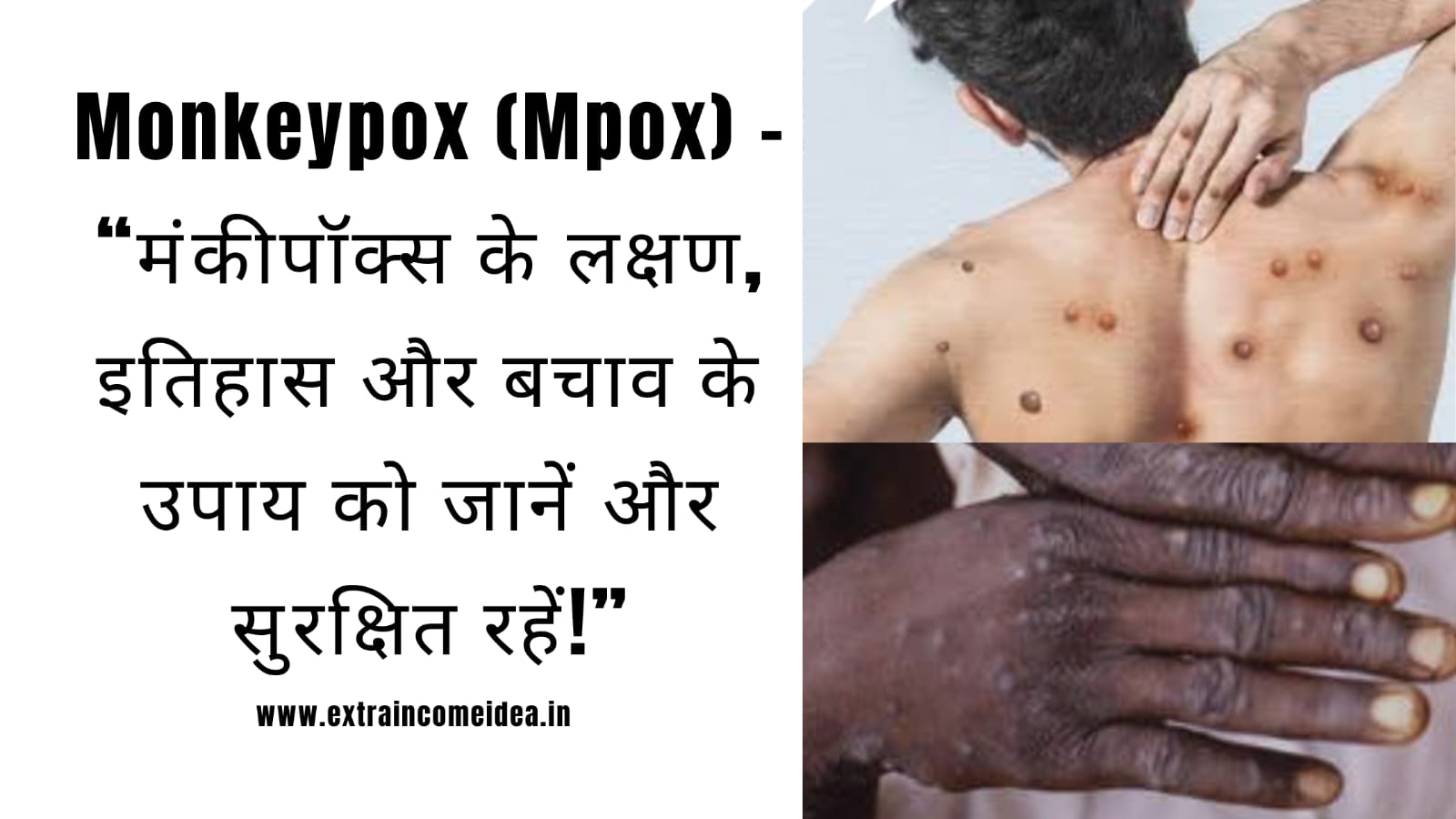 monkeypox treatment vaccine in india